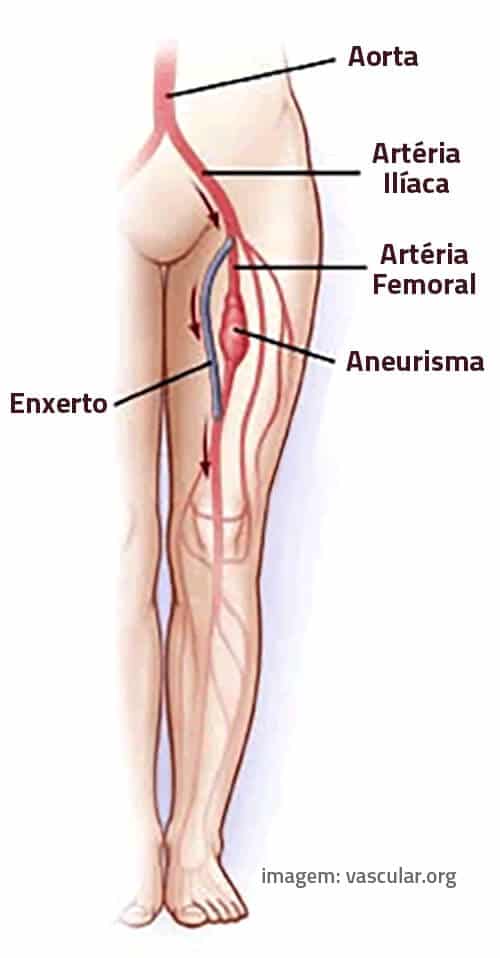 Aneurisma Periférico