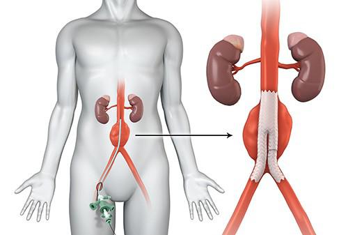 tratamento aneurisma aorta